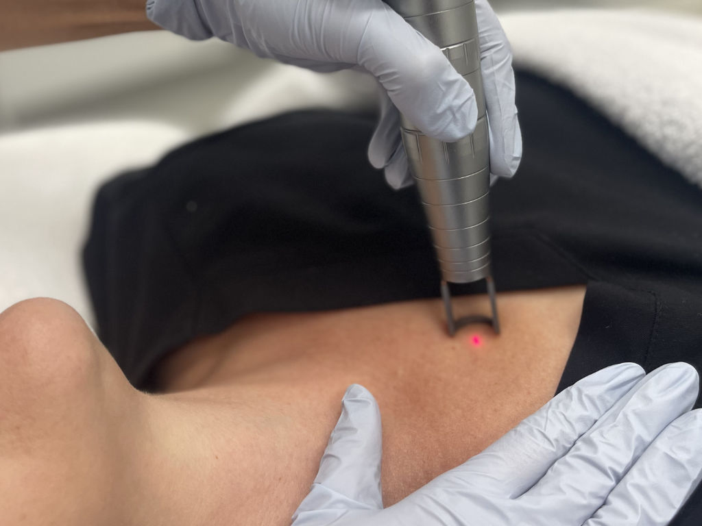 CARBON LASER CHEST AREA